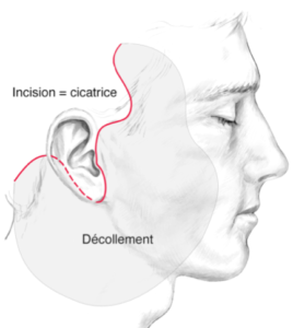 lifting facial